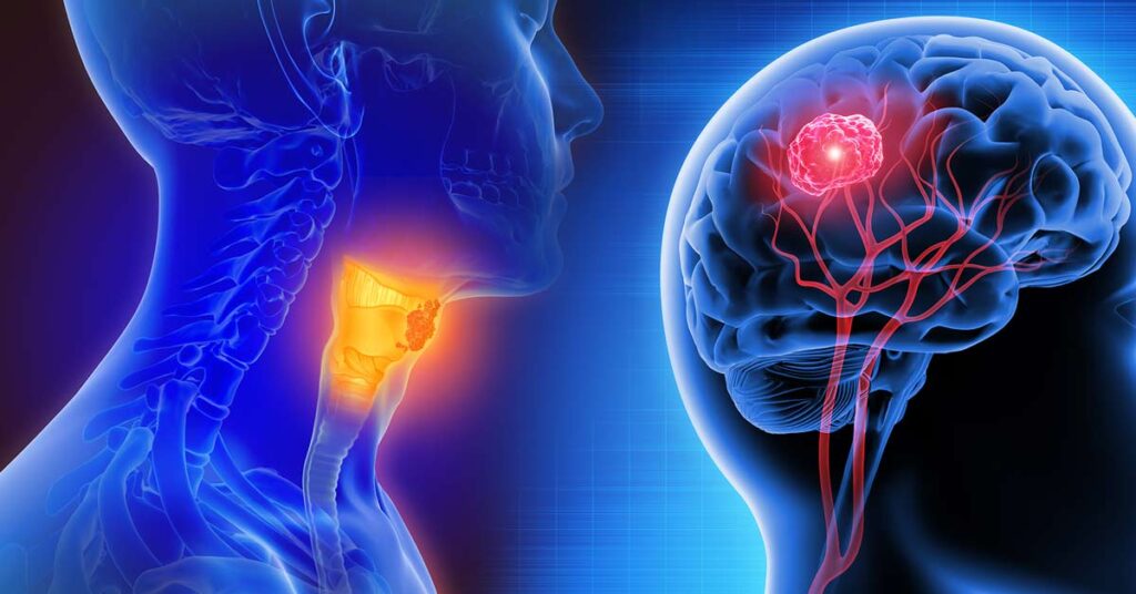 Ilustração tridimensional de tumor na região de cabeça e pescoço, usada em estudos de estadiamento e prognóstico