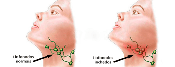 Comparação ilustrada entre linfonodos normais e linfonodos aumentados na região cervical