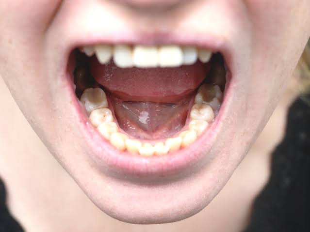 Boca aberta permitindo a visualização do assoalho bucal e da face inferior da língua