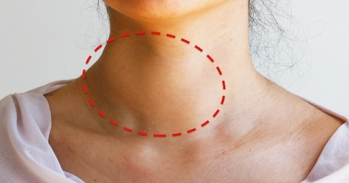 Destaque da região lateral do pescoço onde um nódulo cervical costuma ser percebido