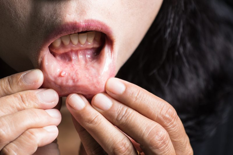 Pessoa afastando o lábio inferior para inspecionar a mucosa oral durante o autoexame da boca